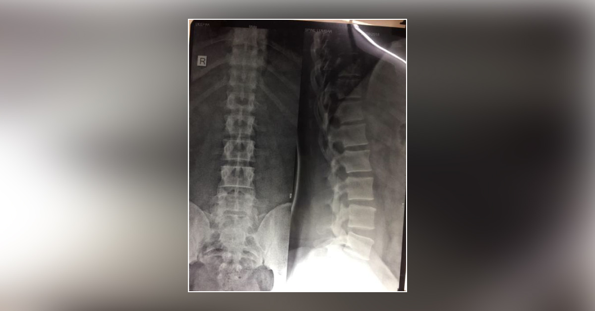 What Is In The Fourth Lumber Vertebral Interspinous Processes?