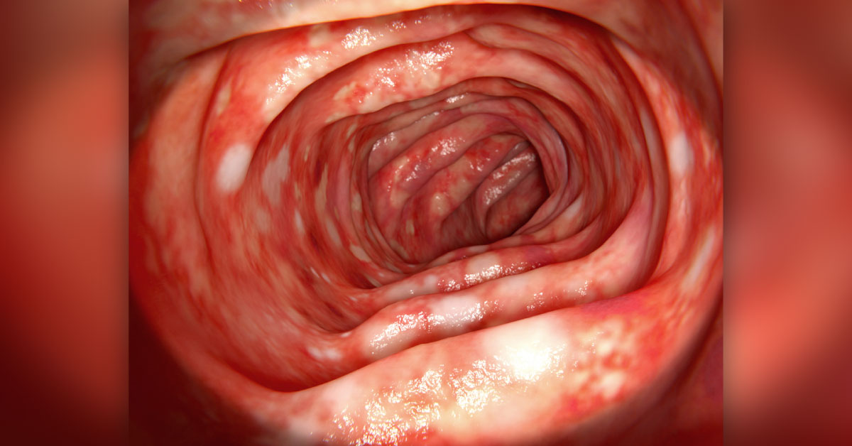 Bloody Diarrhea, Lower Abdominal Cramping: What's the Diagnosis?