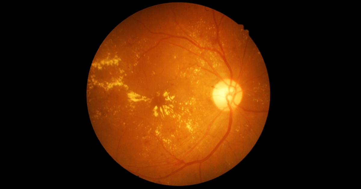 Ocular Manifestations Of Dengue Fever