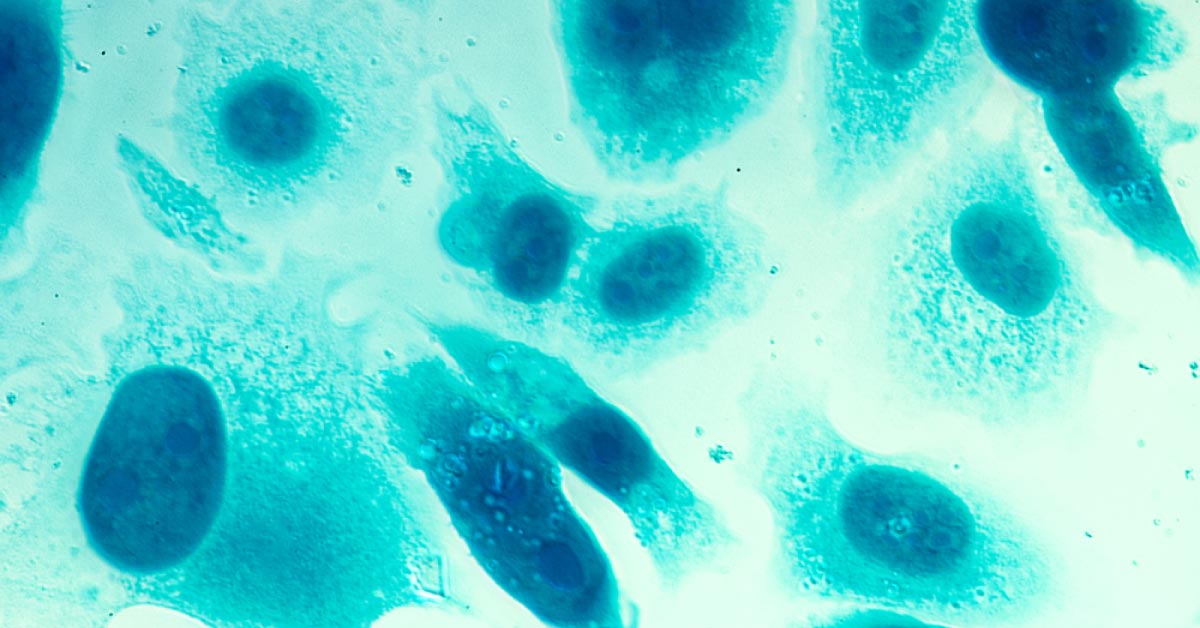 Androgen Deprivation Therapy