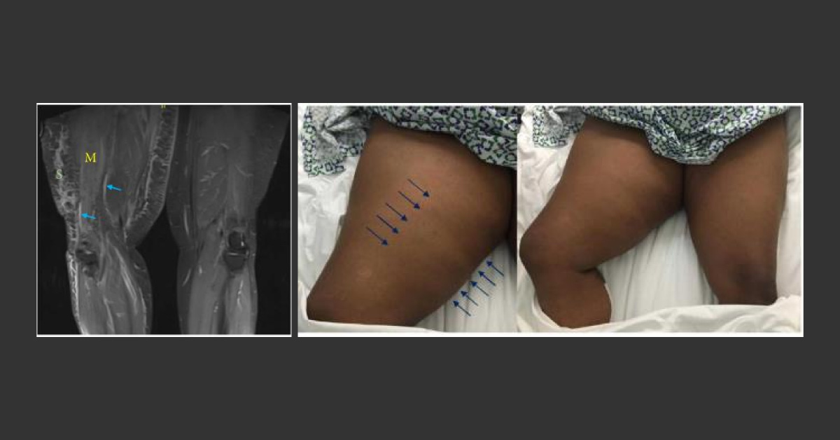 What is the Cause of Leg Pain in This Patient?