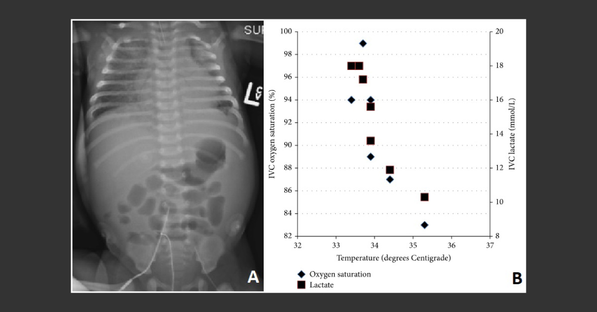 Respiratory Distress in a Term Infant: What Is Your Diagnosis?