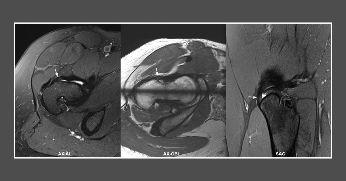 Case of a Female Dancer with Hip Injury