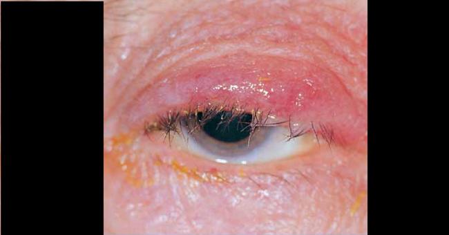 Spot This Ophthalmic Condition