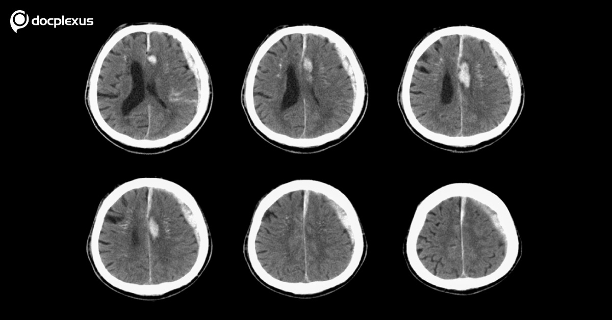 Acute Subdural Hematoma: Which Predictive Outcome Factors Do You Consider?
