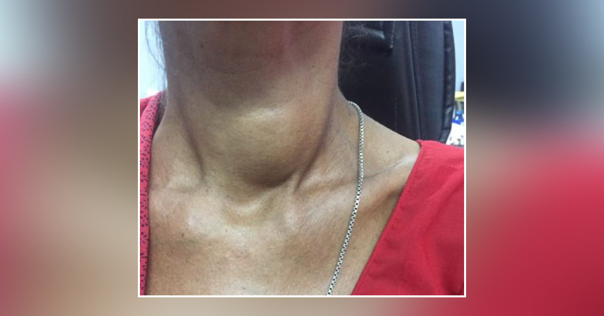 Unable To Take Breath After Meals, In A Patient Of Hyperthyroidism After Starting Treatment