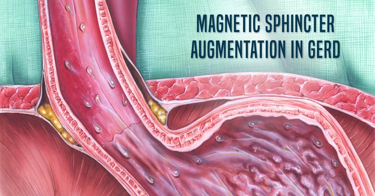 Magnetic Sphincter Augmentation Better Than PPIs In GERD