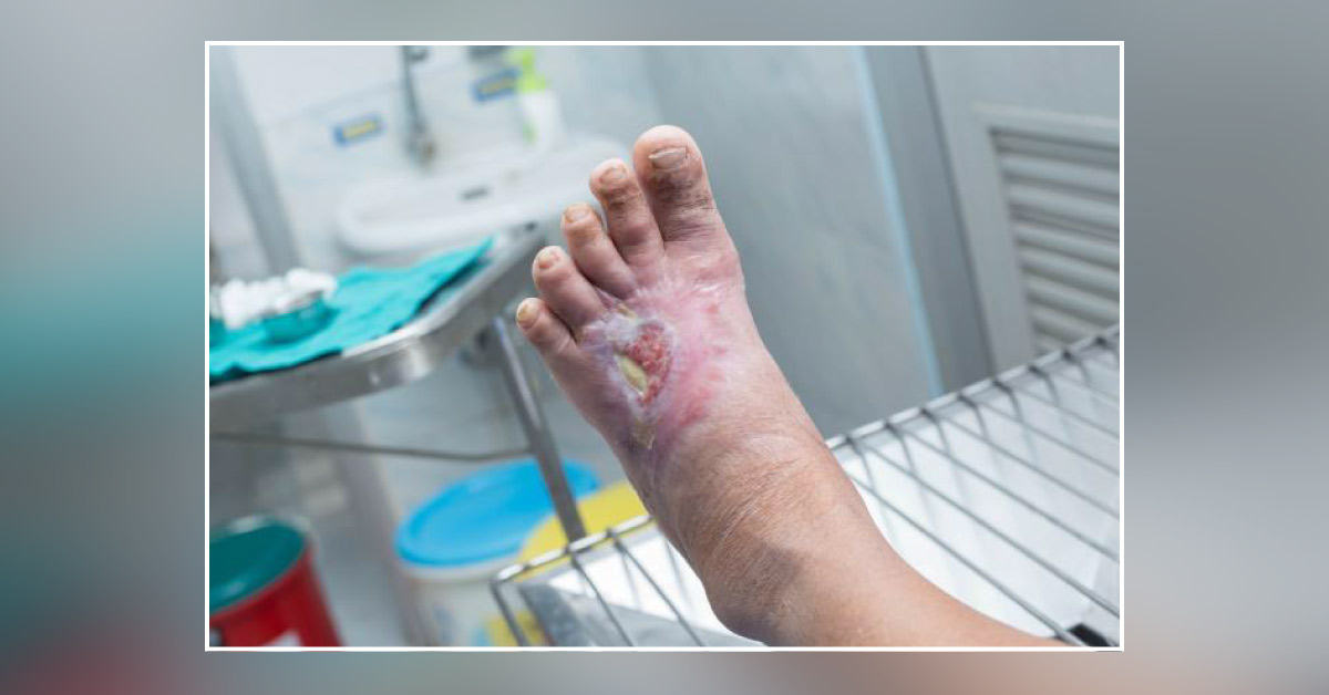 Cardinal Features Of Diabetic Foot