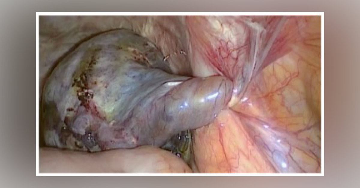 Pain Following Laparoscopic Hysterectomy: What is Your Diagnosis?