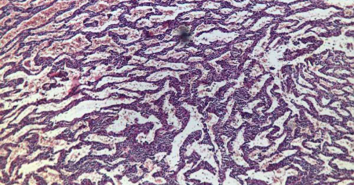 A Lumbar Subcutaneous Mass With Multiple D/D