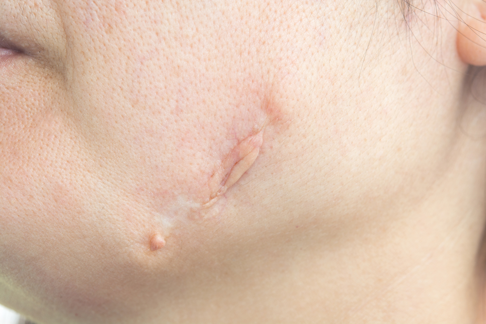 New Cosmetic Agents Available To Fill Up Facial Scars