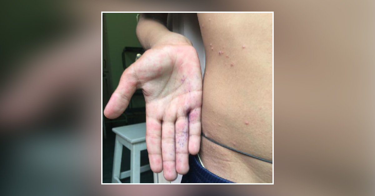 Chicken Pox Or Drug Allergy Eruptions?