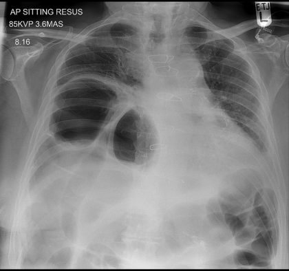 Computer-aided Detection In Chest Radiography Based On Artificial Intelligence Is The Best Reporting