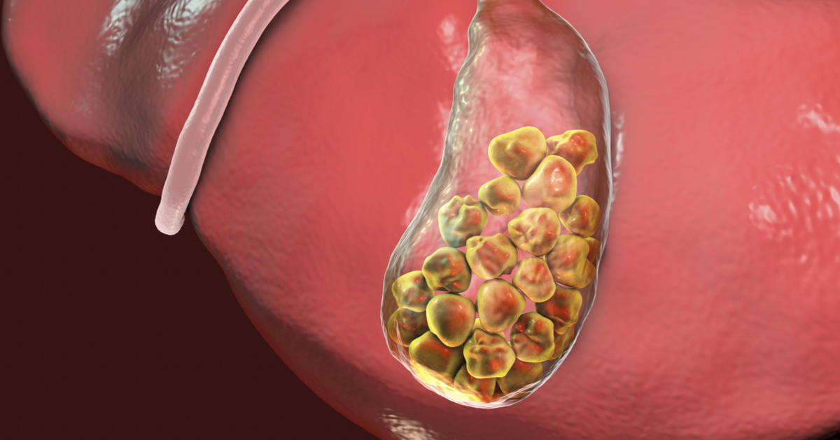 Doctor In Kolkata Removes 10000 Gallstones From A Female Nutritionist
