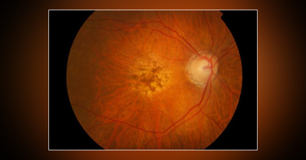 Ocular Side Effects Of Prostaglandin Analogues