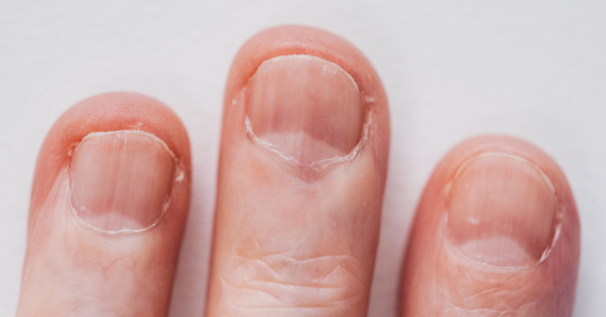 Pinpoint Area of Tenderness at the Nail