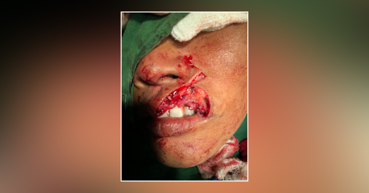 Case Of Suspected Keloid Of Upper Lip