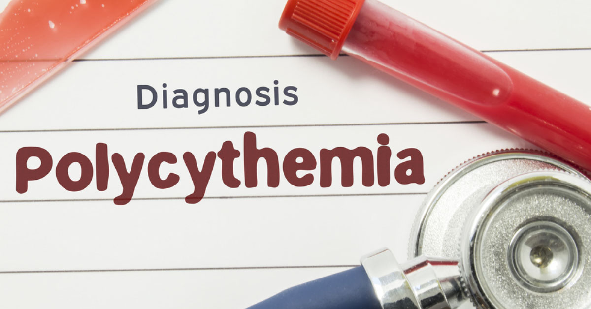 Diagnostic Crossroads: Polycythemia Vera (Masked By Iron Deficiency) And Thalassaemia Minor