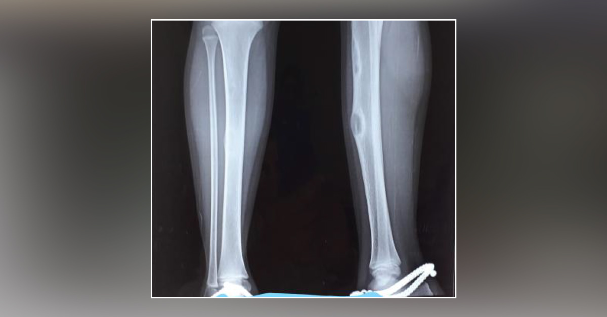 Case Of Palpable Small Lump Over Mid-Shin