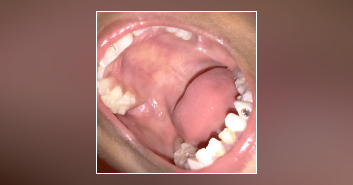 Brief Review On A High-Arched Palate