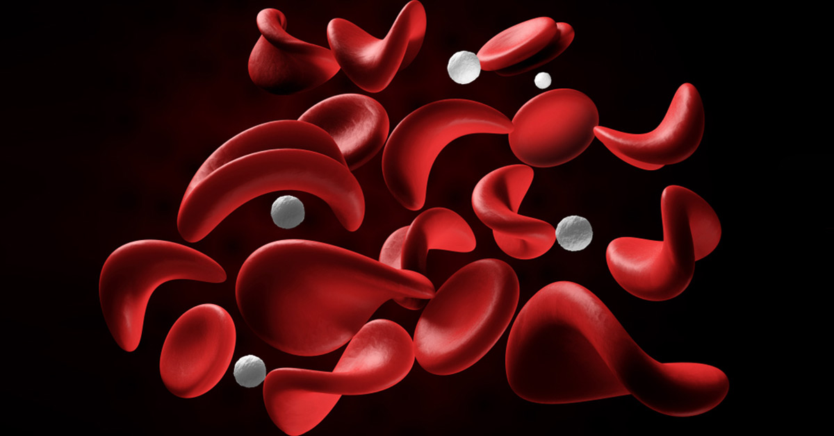 L-Glutamine For Sickle Cell Disease