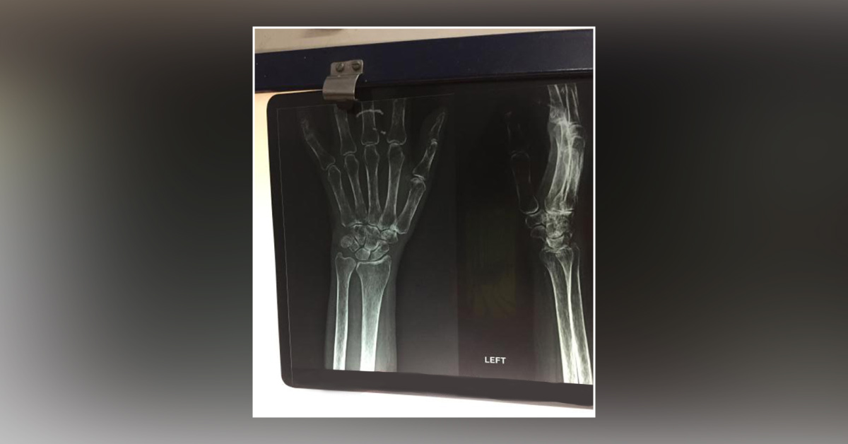 What Is The Disease In Carpals And Other Bones Of Hand?