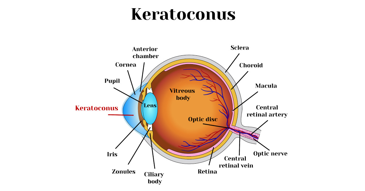 Brief Review On Treatment Of Keratoconus