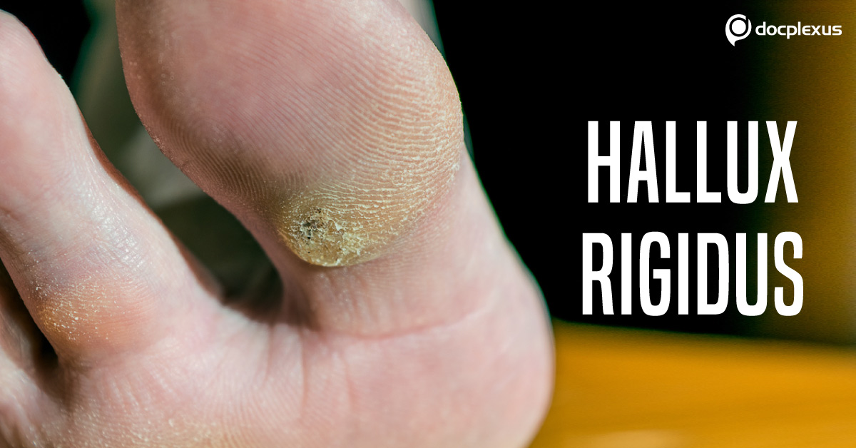 Effective Surgical Procedures For The Treatment Of Hallux Rigidus