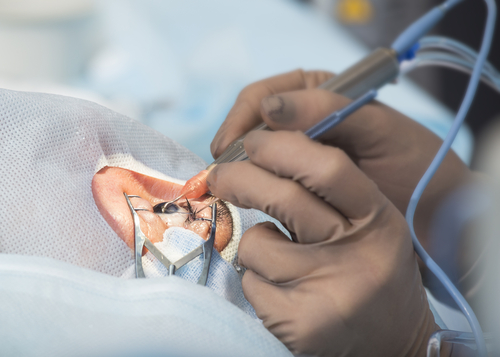 Brief Review On Recent Surgical Modalities In Ophthalmology