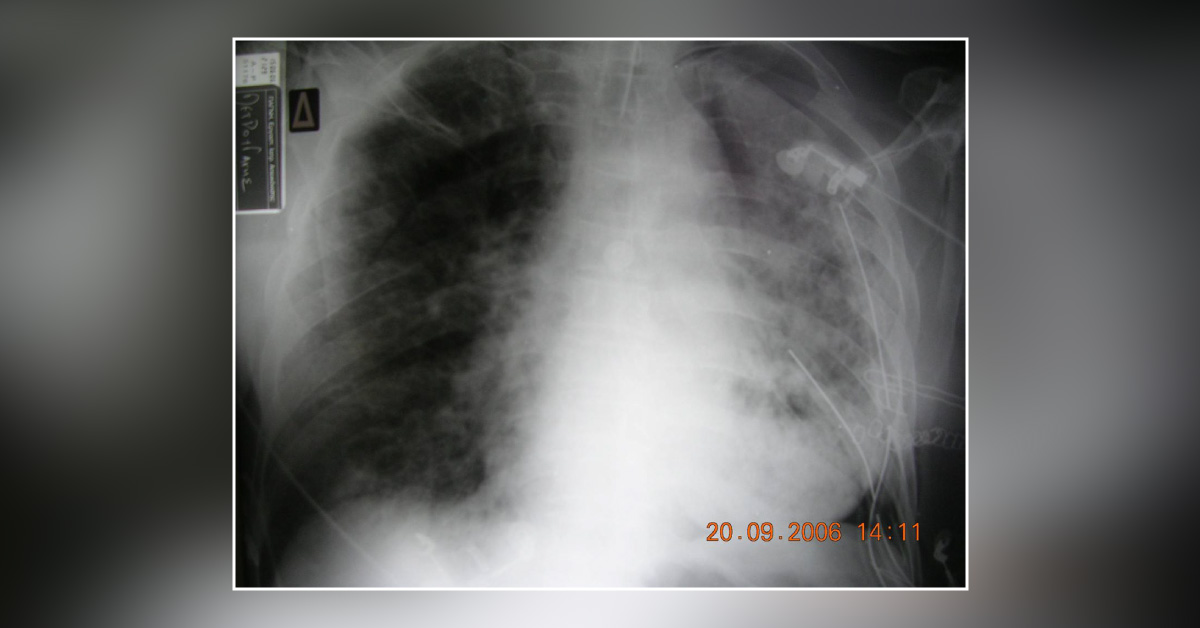 Acute Respiratory Failure Post Resection: What is Your Diagnosis?
