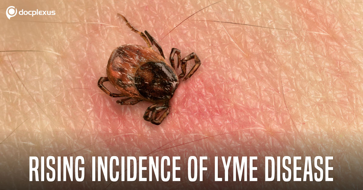 Diagnosis and Management of Lyme Disease