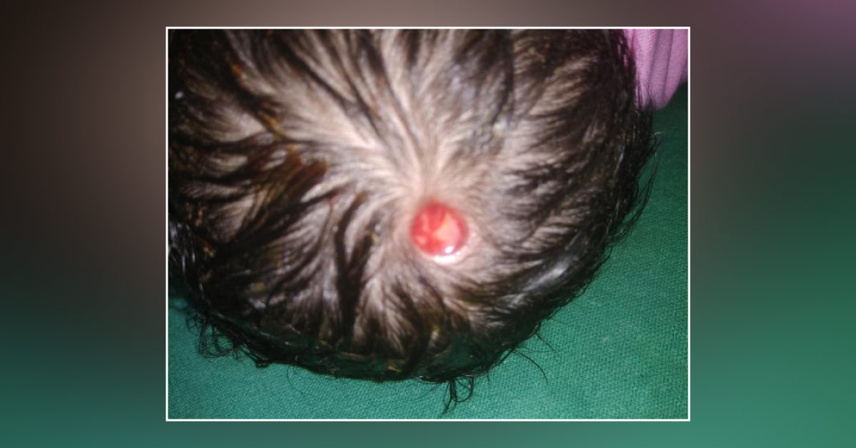 Case Of Ulceration Over The Scalp