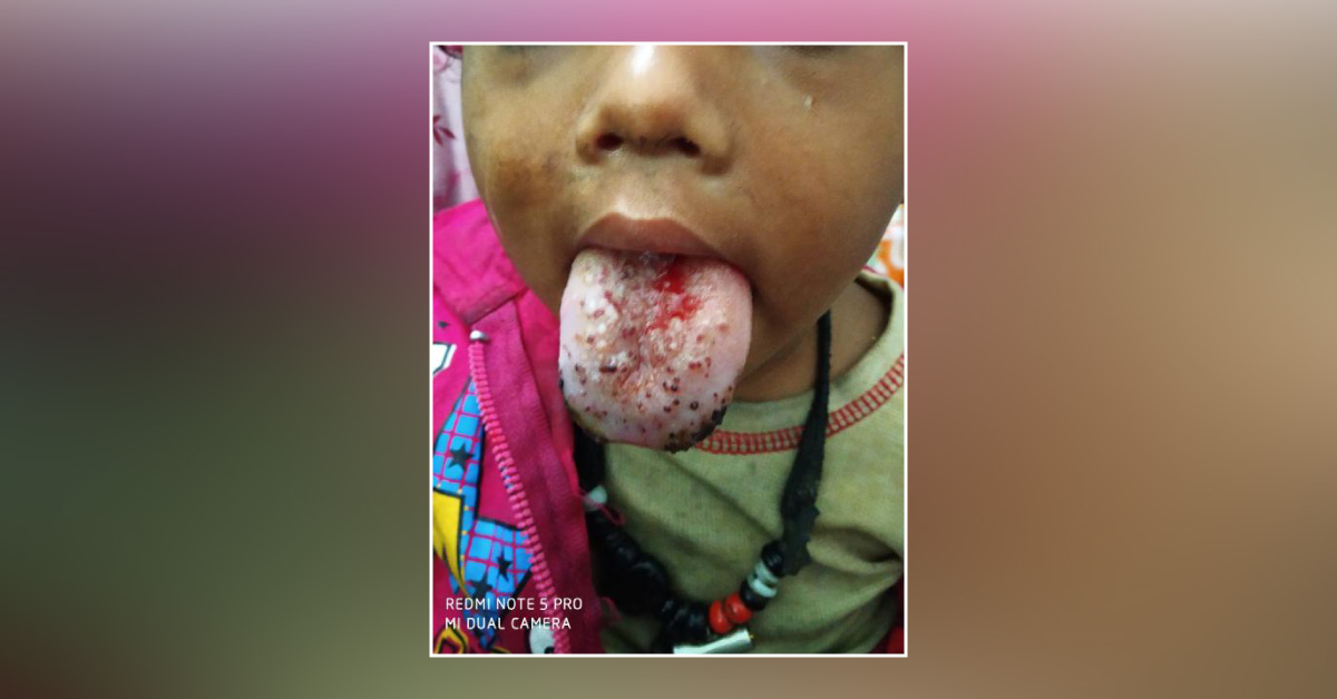 Case Of Tongue Protrusion