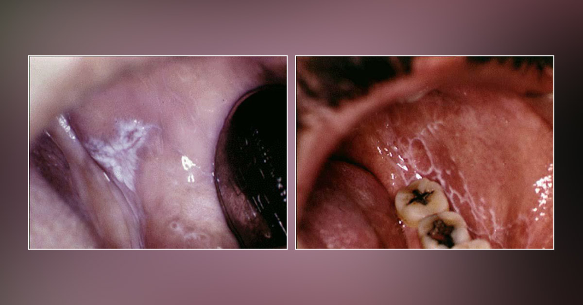 Potential Triggers of Oral Lichen Planus