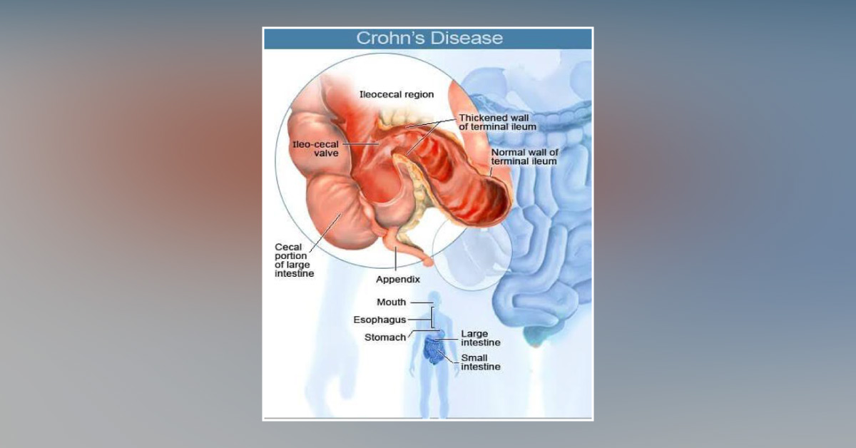 New Antibiotic Cocktail Shows Promise In Treatment Of Crohn's Disease
