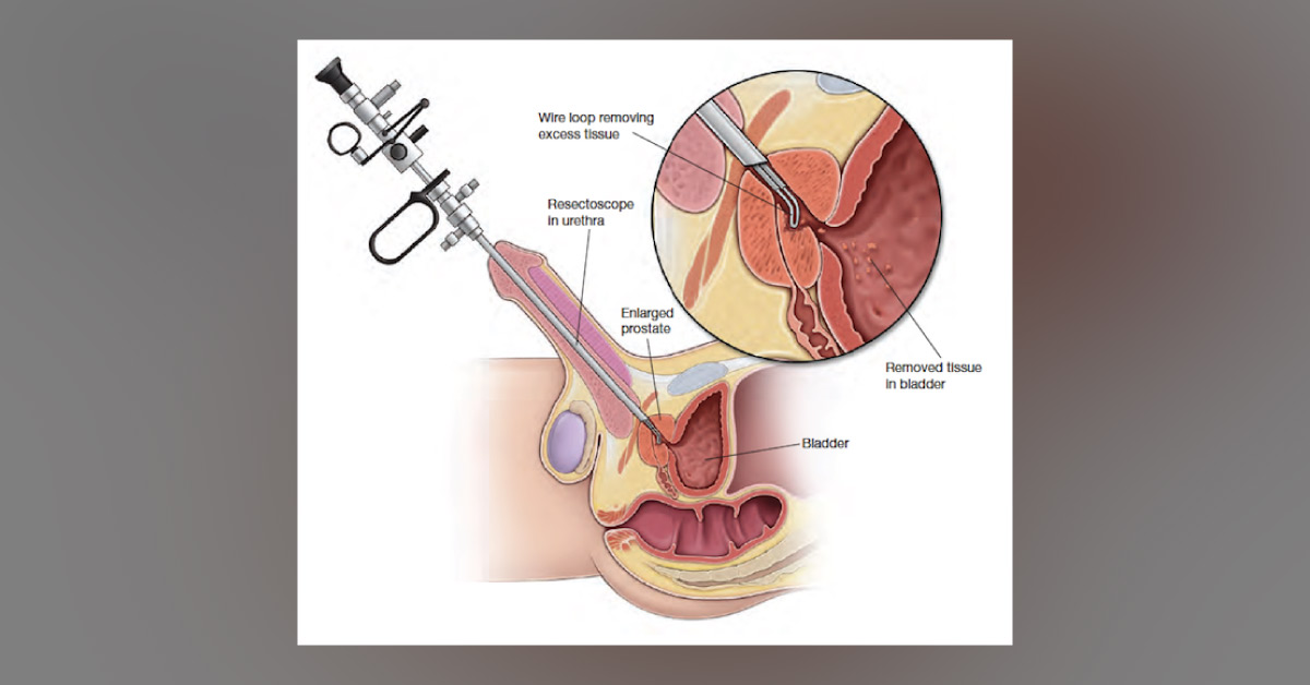 Brief on Transurethral Resection of Prostate