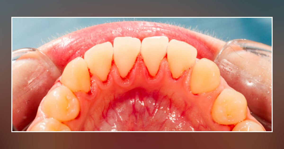 Severe Gum Disorder Seen In This Male