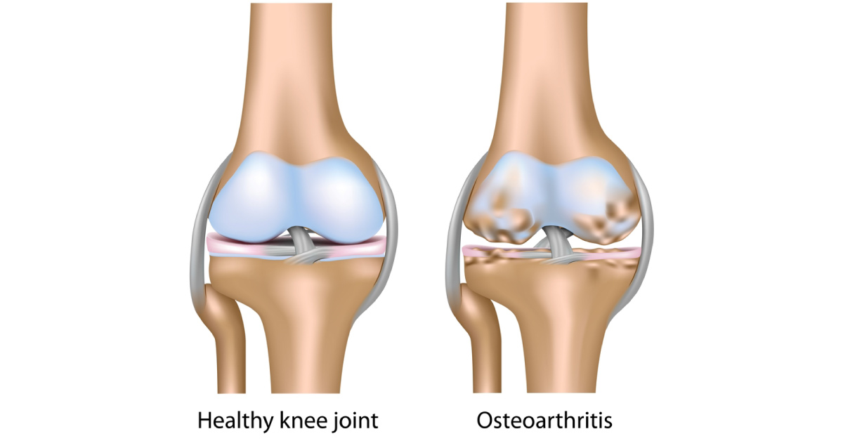 Potential Treatment Could Stop Knee And Spine Osteoarthritis, Scientists New Invention