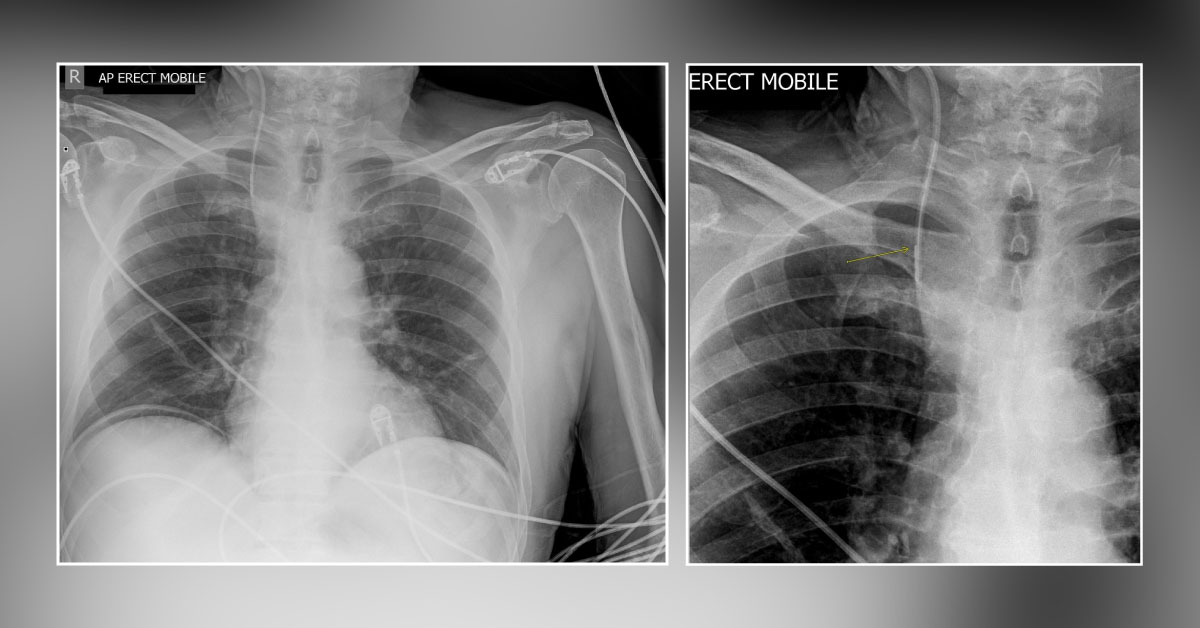 Post Colectomy Xray