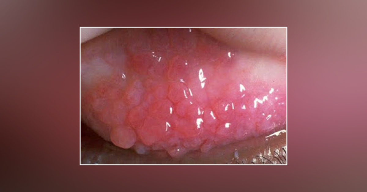 The Older Medication Of Vernal Keratoconjunctivitis