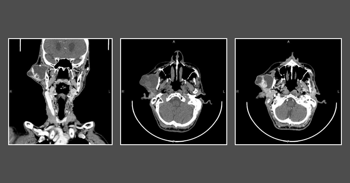 Case of a Patient with Painless Swelling in Parotid Gland