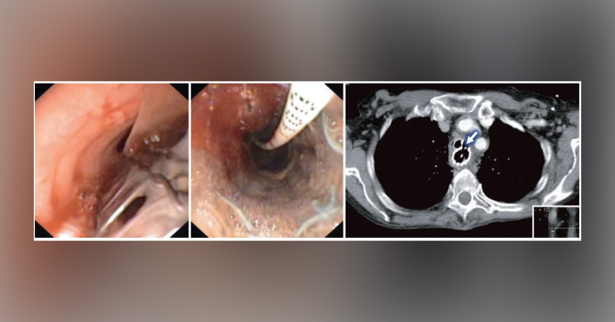 A 63-year-old Woman With Dysphagia