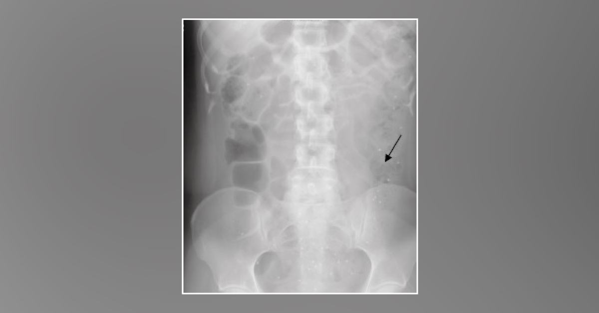 Case of a Woman with Severe Constipation