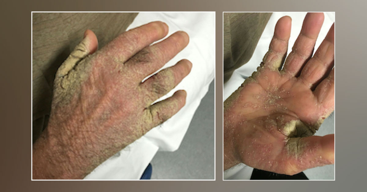 A Man with Thick Warty Crusts on His Hands