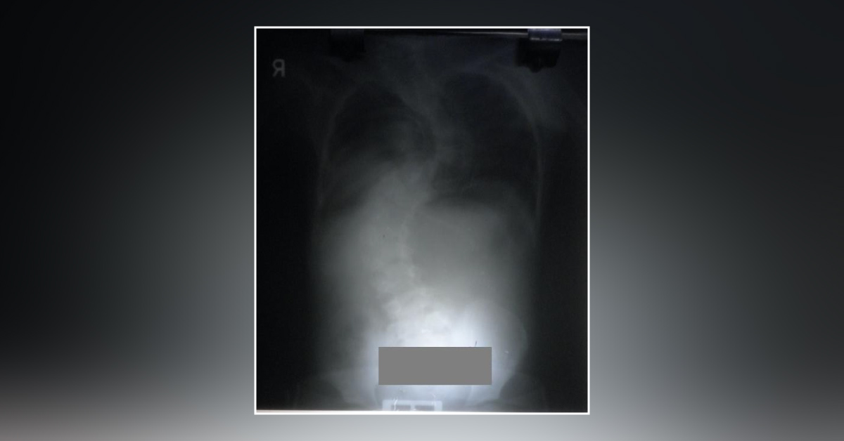 Interpret The X-ray Chest