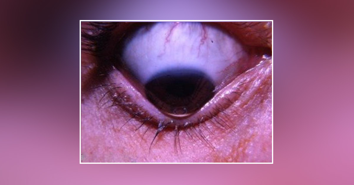 Review On Keratoconus