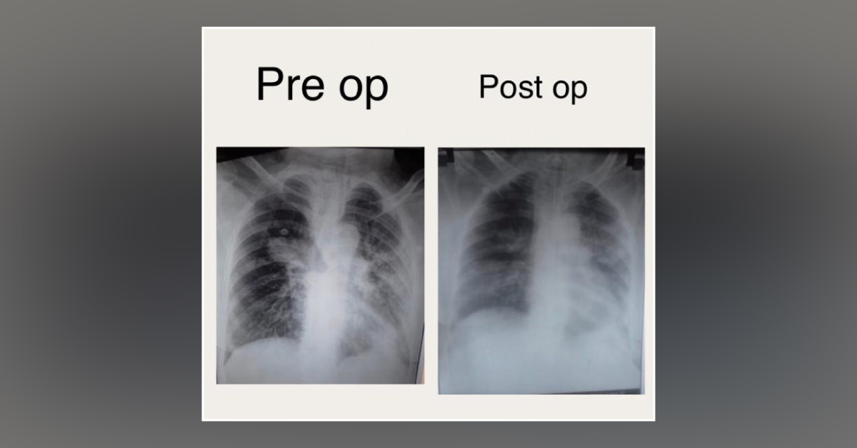 Resection Of Bronchial Tumour Through Rigid Bronchoscopy 
“ Sharing Airway A Difficult Task “