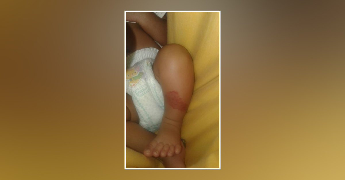Does Child With Hemangioma Needs To Avoid Vaccination?