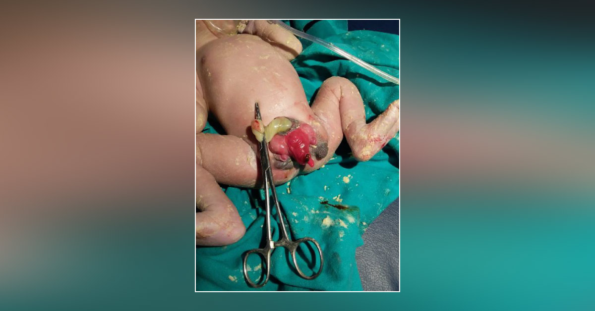 Case Of Abnormal Genital Configuration In Baby