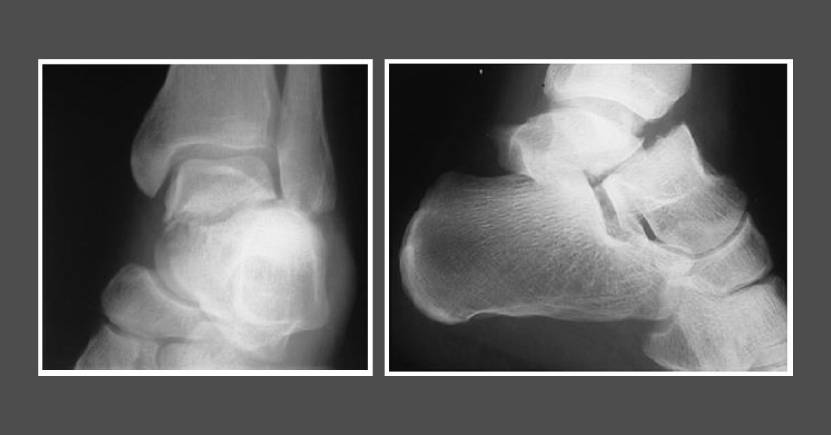 A Painful Foot Following A Traffic Incident
